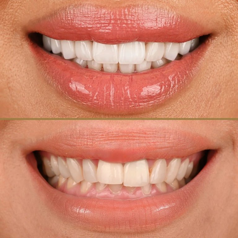  Benefits of Veneers